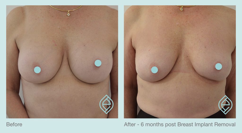 Breast Implant Removal | Ethique Plastic Surgery | Dr Andre Safvat | Bowral, Miranda, Concord, Sydney