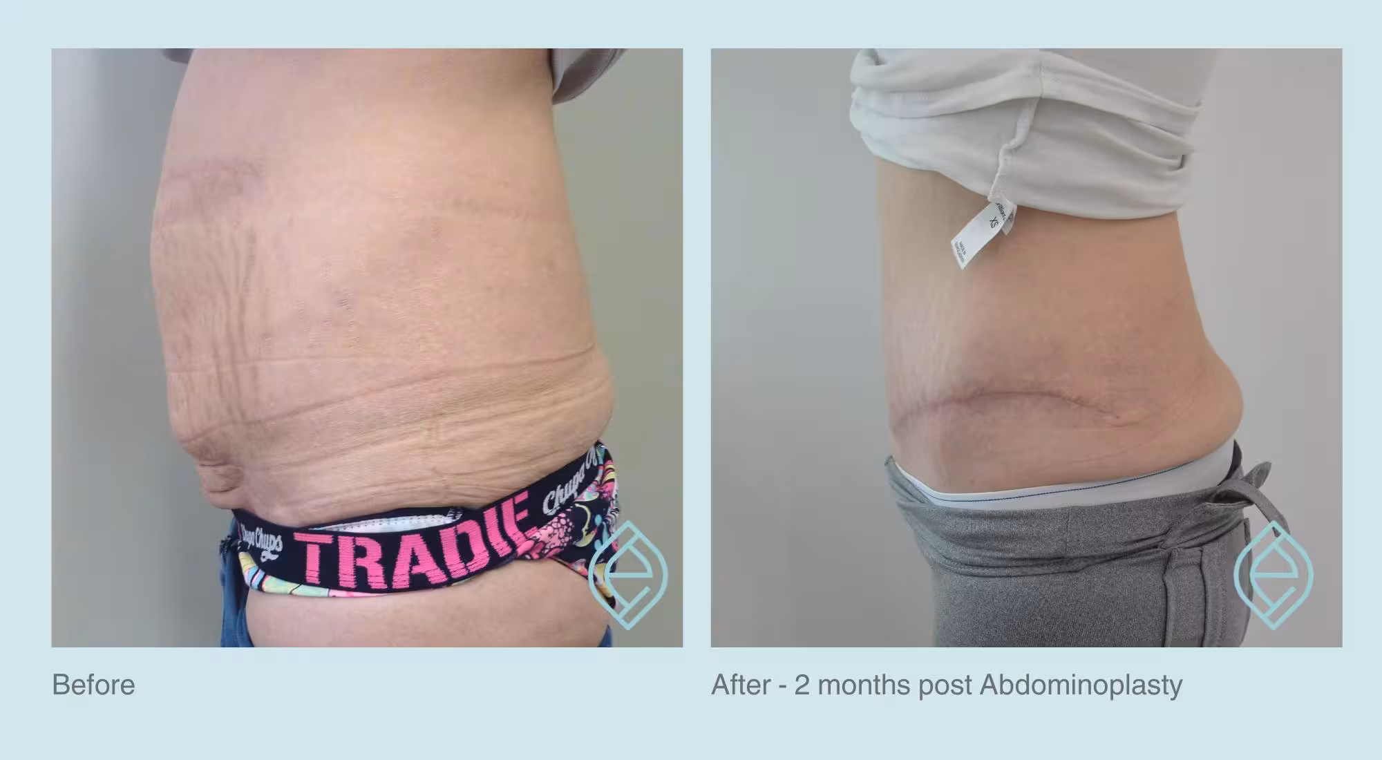 Abdominoplasty and Body Lift | Before and After Abdominoplasty and Body Lift | Before and After | Ethique Plastic Surgery | Dr André Safvat | Miranda | Bowral | Concord | New South Wales