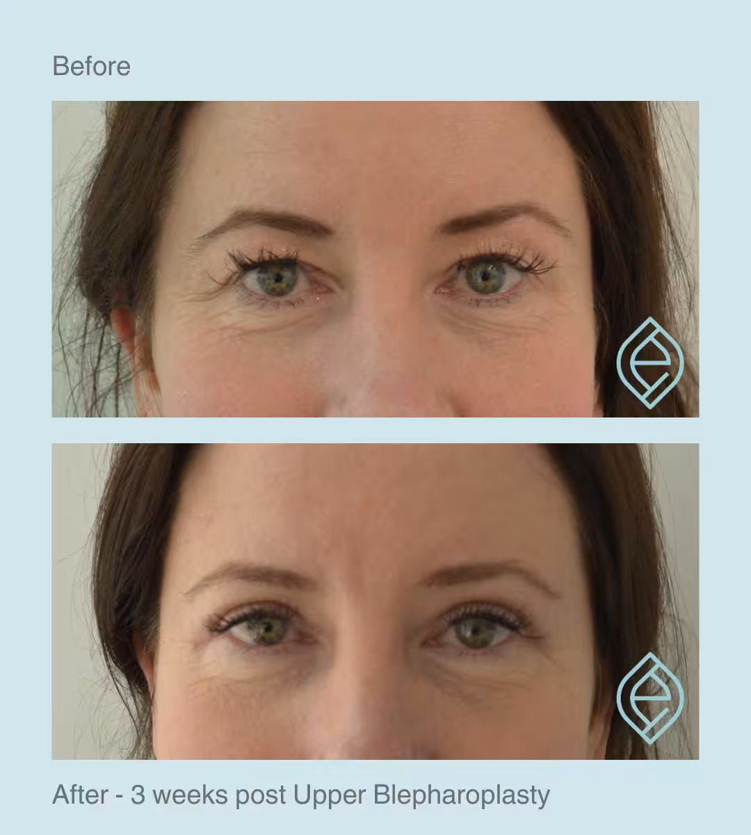 Blepharoplasty | Before and After Blepharoplasty | Before and After | Ethique Plastic Surgery | Dr André Safvat | Miranda | Bowral | Concord | New South Wales