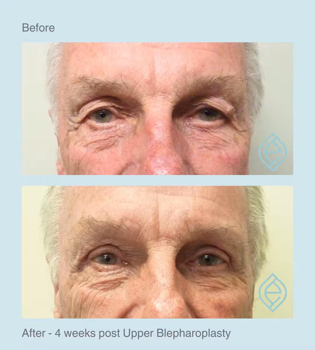 Blepharoplasty | Before and After Blepharoplasty | Before and After | Ethique Plastic Surgery | Dr André Safvat | Miranda | Bowral | Concord | New South Wales