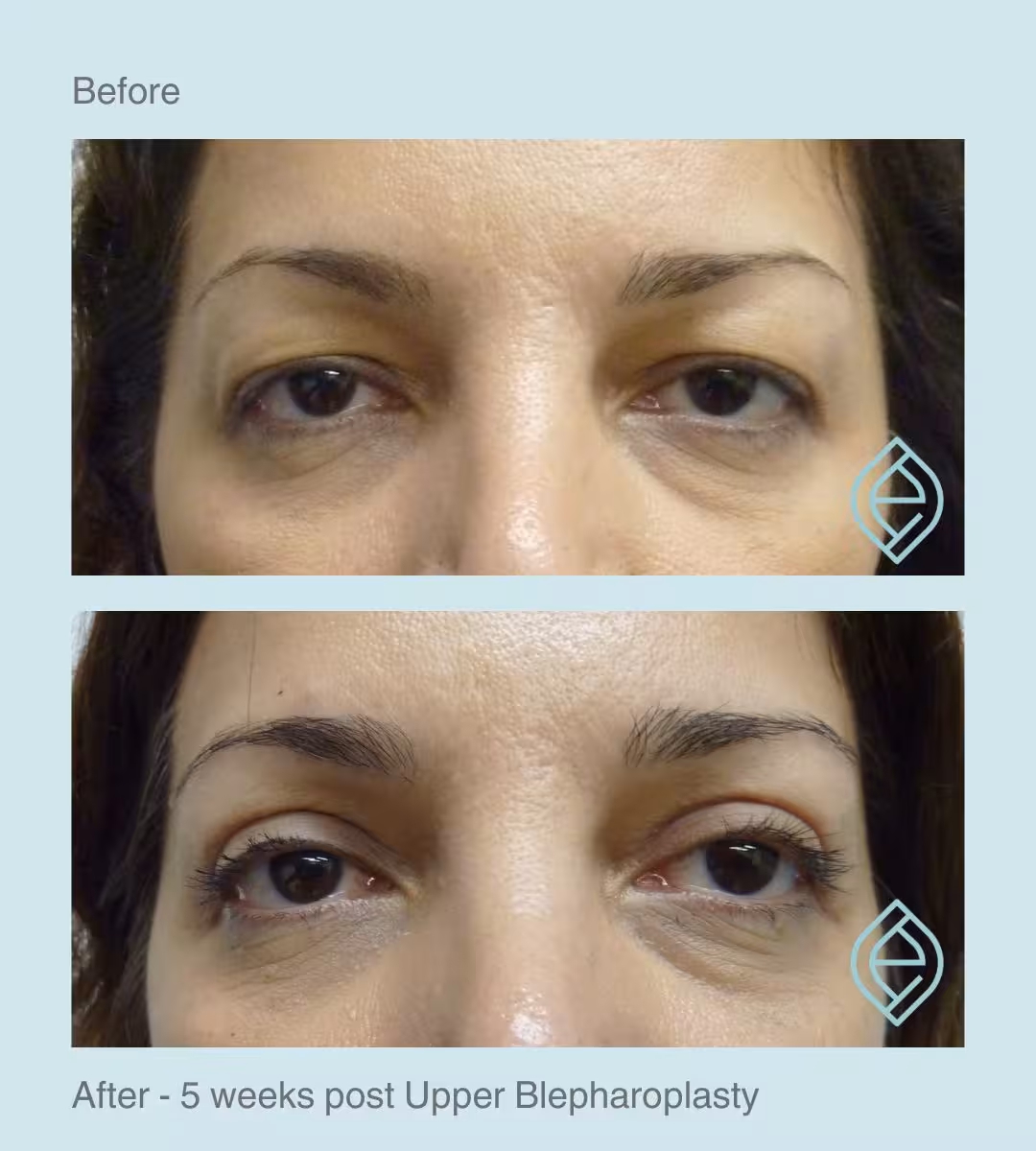 Blepharoplasty | Before and After Blepharoplasty | Before and After | Ethique Plastic Surgery | Dr André Safvat | Miranda | Bowral | Concord | New South Wales