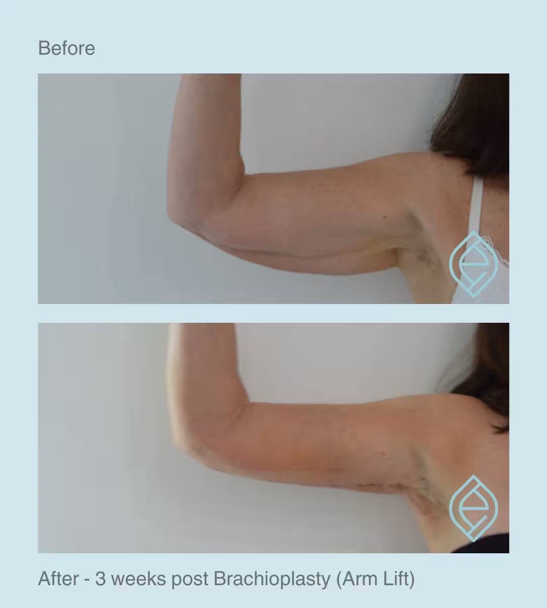 Brachioplasty | Before and After Brachioplasty | Before and After | Ethique Plastic Surgery | Dr André Safvat | Miranda | Bowral | Concord | New South Wales