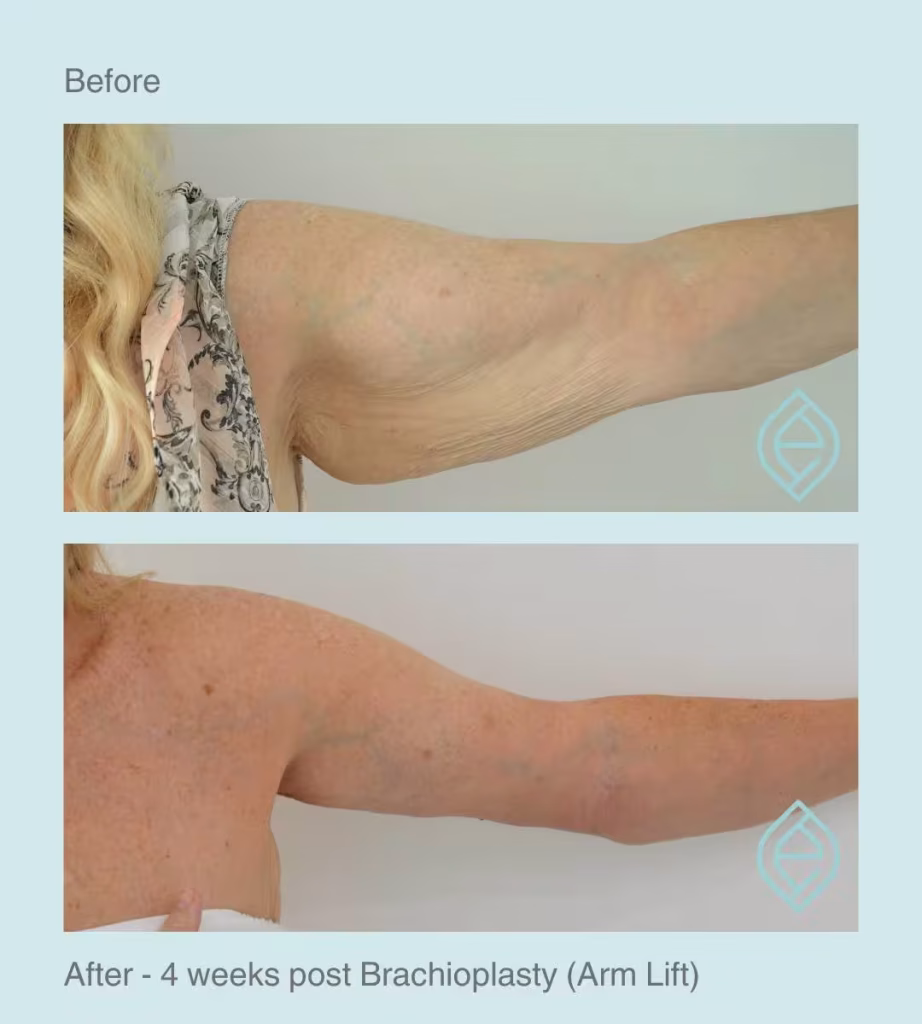 Brachioplasty | Before and After | Ethique Plastic Surgery | Dr André Safvat | Miranda | Bowral | Concord | New South Wales