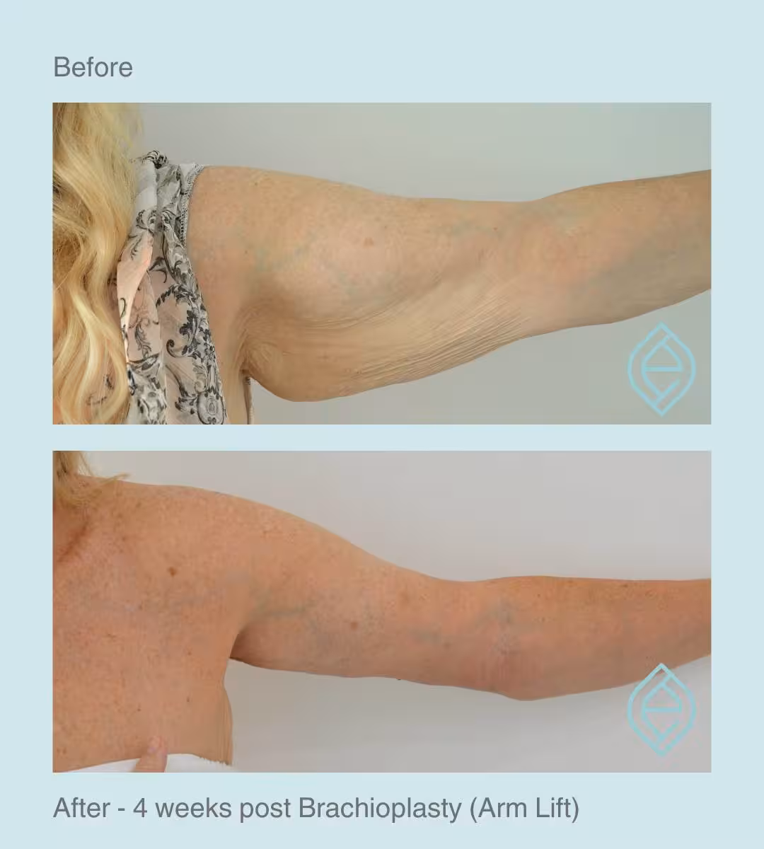 Brachioplasty | Before and After Body Contouring After Weight Loss | Brachioplasty | Before and After | Ethique Plastic Surgery | Dr André Safvat | Miranda | Bowral | Concord | New South Wales