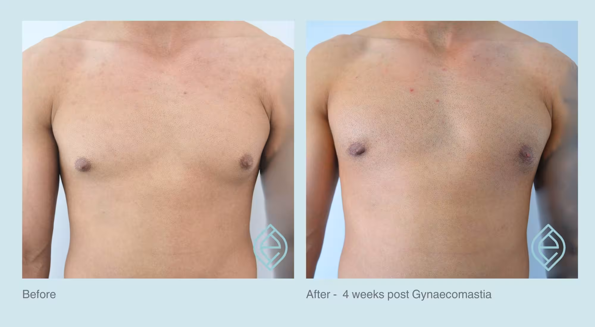 Gynaecomastia | Before and After | Ethique Plastic Surgery | Dr André Safvat | Miranda | Bowral | Concord | New South Wales