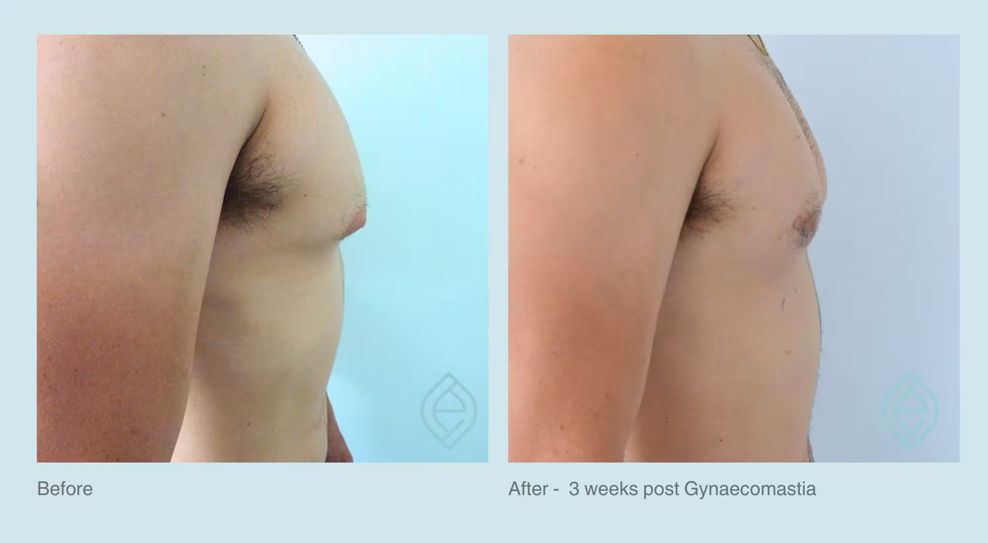 Gynaecomastia | Before and After | Ethique Plastic Surgery | Dr André Safvat | Miranda | Bowral | Concord | New South Wales
