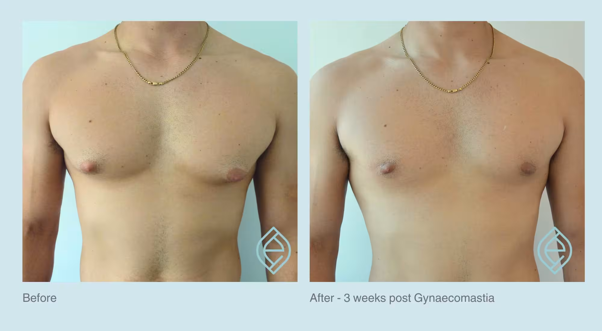 Gynaecomastia | Before and After | Ethique Plastic Surgery | Dr André Safvat | Miranda | Bowral | Concord | New South Wales