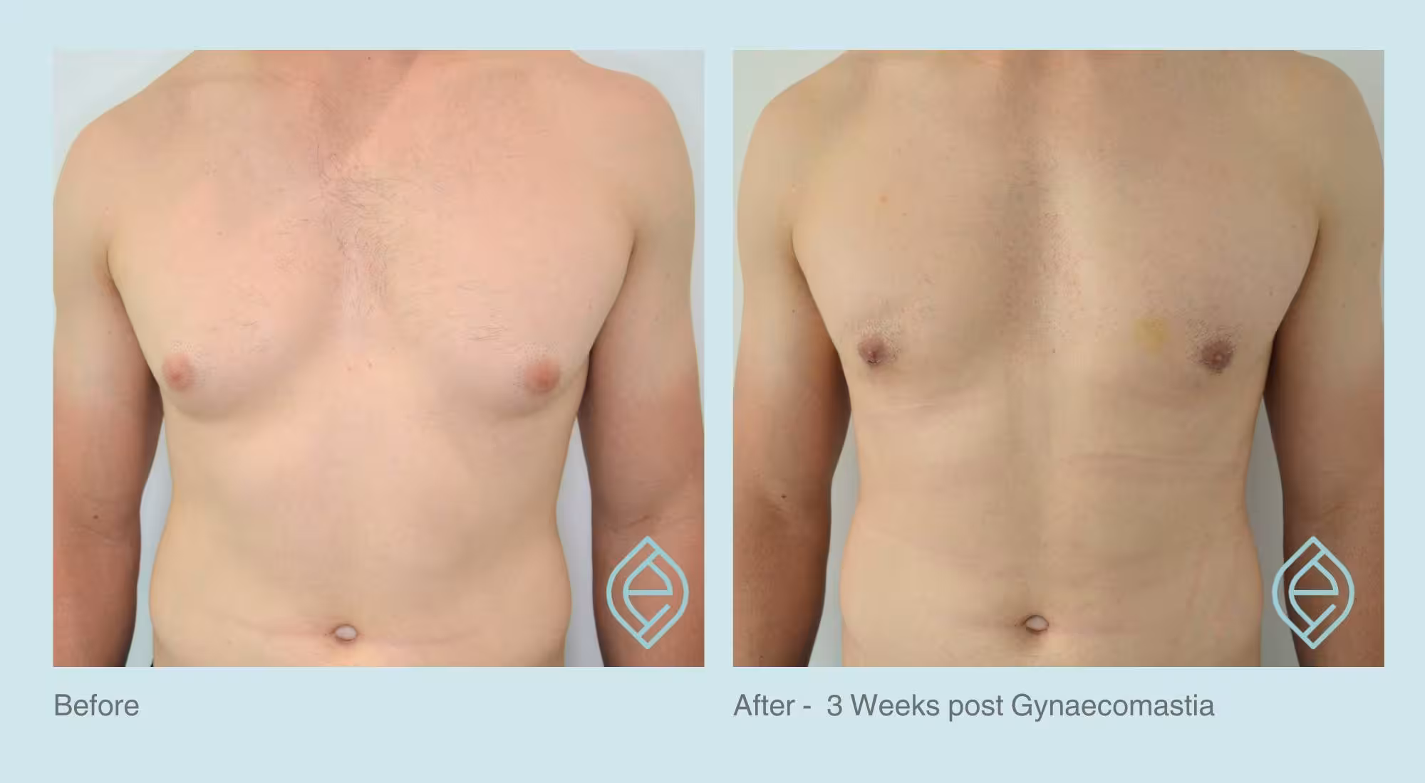 Gynaecomastia | Before and After | Ethique Plastic Surgery | Dr André Safvat | Miranda | Bowral | Concord | New South Wales