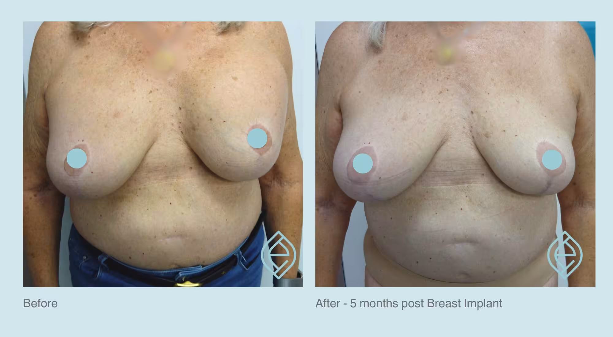 Before-and-After-Implant-Removal