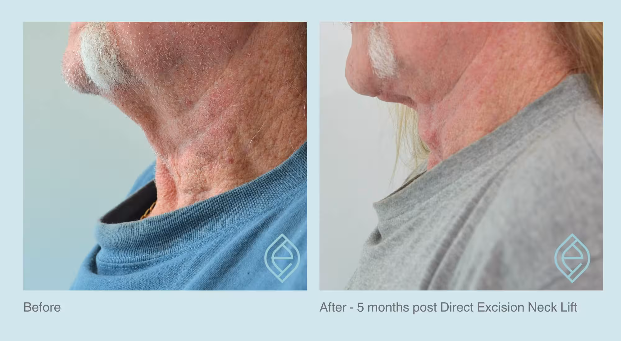 Direct Excision Neck Lift | Before and After Direct Excision Neck Lift | Before and After | Ethique Plastic Surgery | Dr André Safvat | Miranda | Bowral | Concord | New South Wales