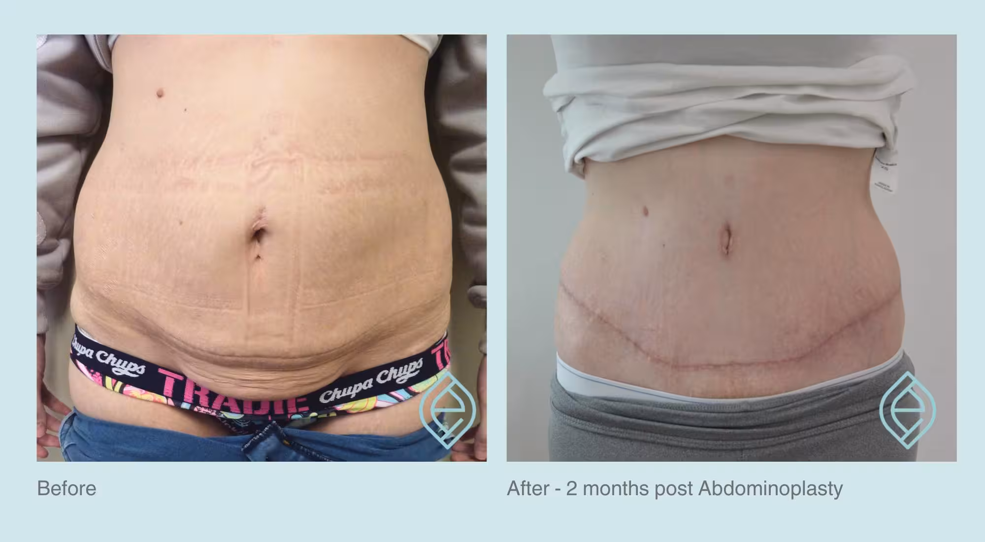 Abdominoplasty and Body Lift | Before and After Abdominoplasty and Body Lift | Before and After | Ethique Plastic Surgery | Dr André Safvat | Miranda | Bowral | Concord | New South Wales